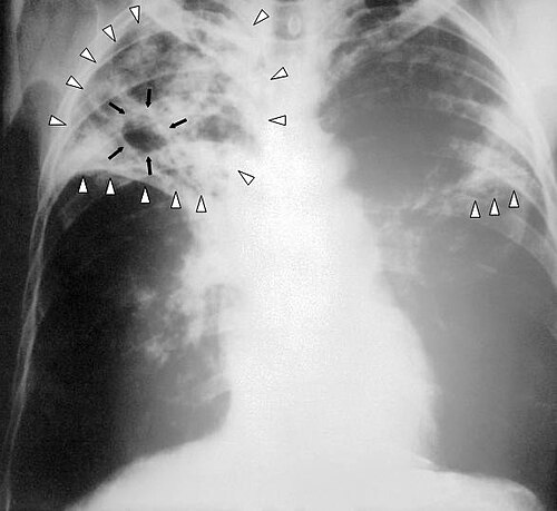 Cavitary tuberculosis — source media 2