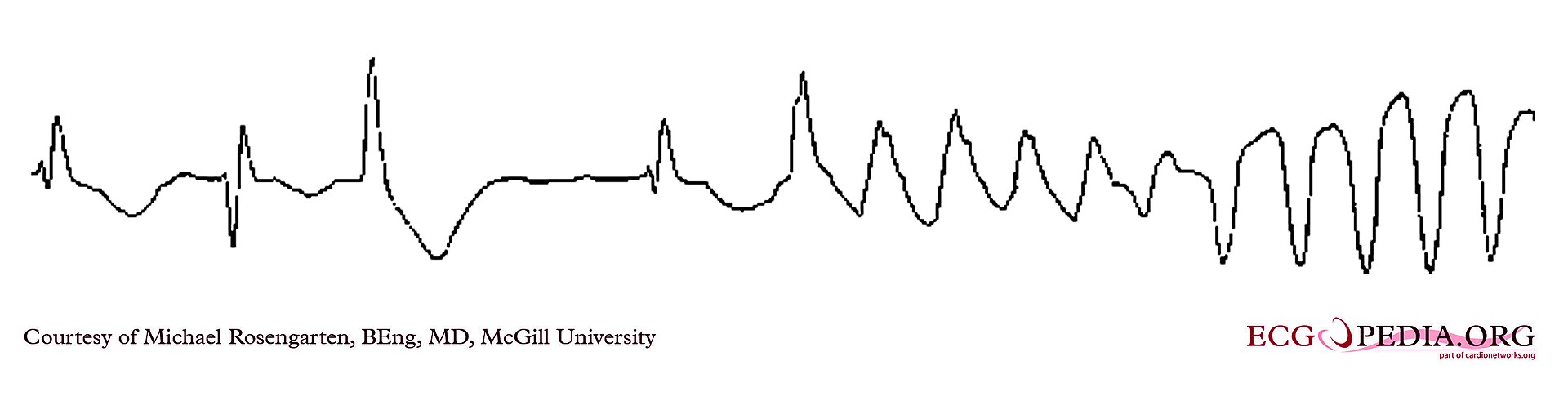 Torsades de pointes — source media 2