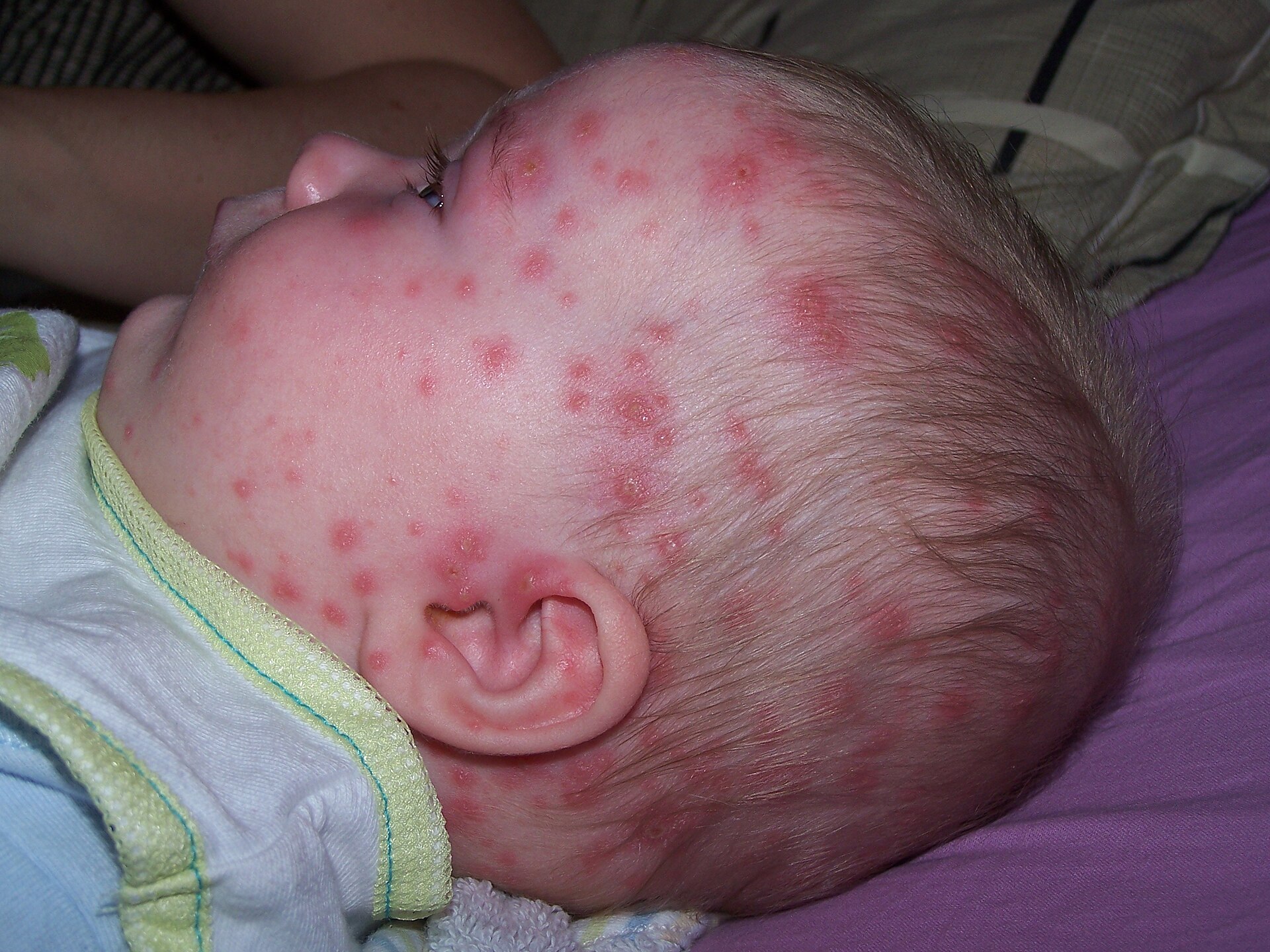 Varicella rash — source media 3