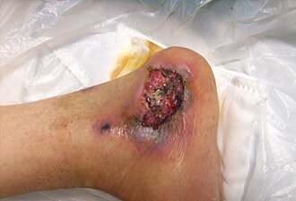 Pressure ulcer — source media 3