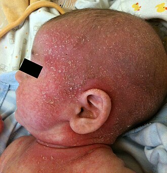 Atopic dermatitis — source media 3