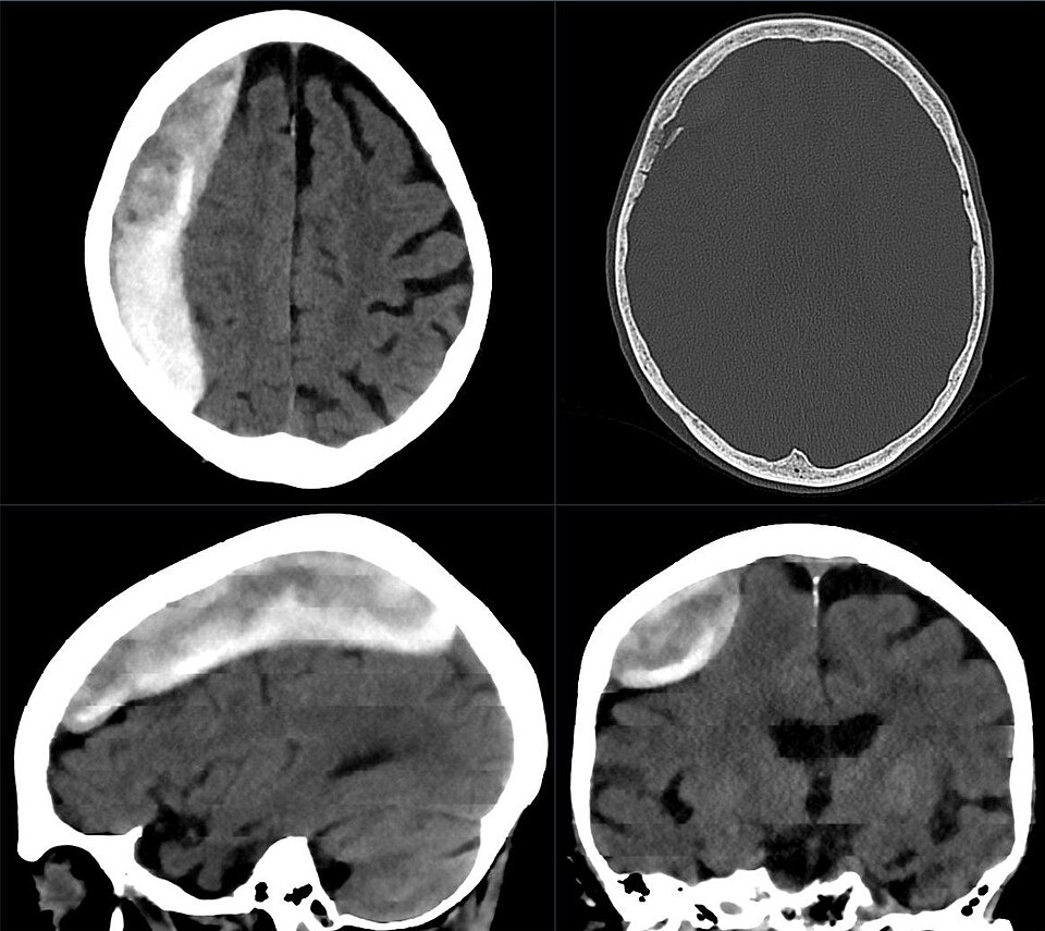 Epidural hematoma CT — source media 3