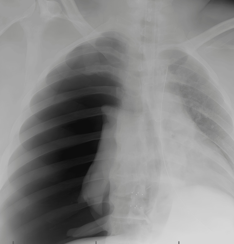 Right tension pneumothorax with left mediastinal shift — source media 2
