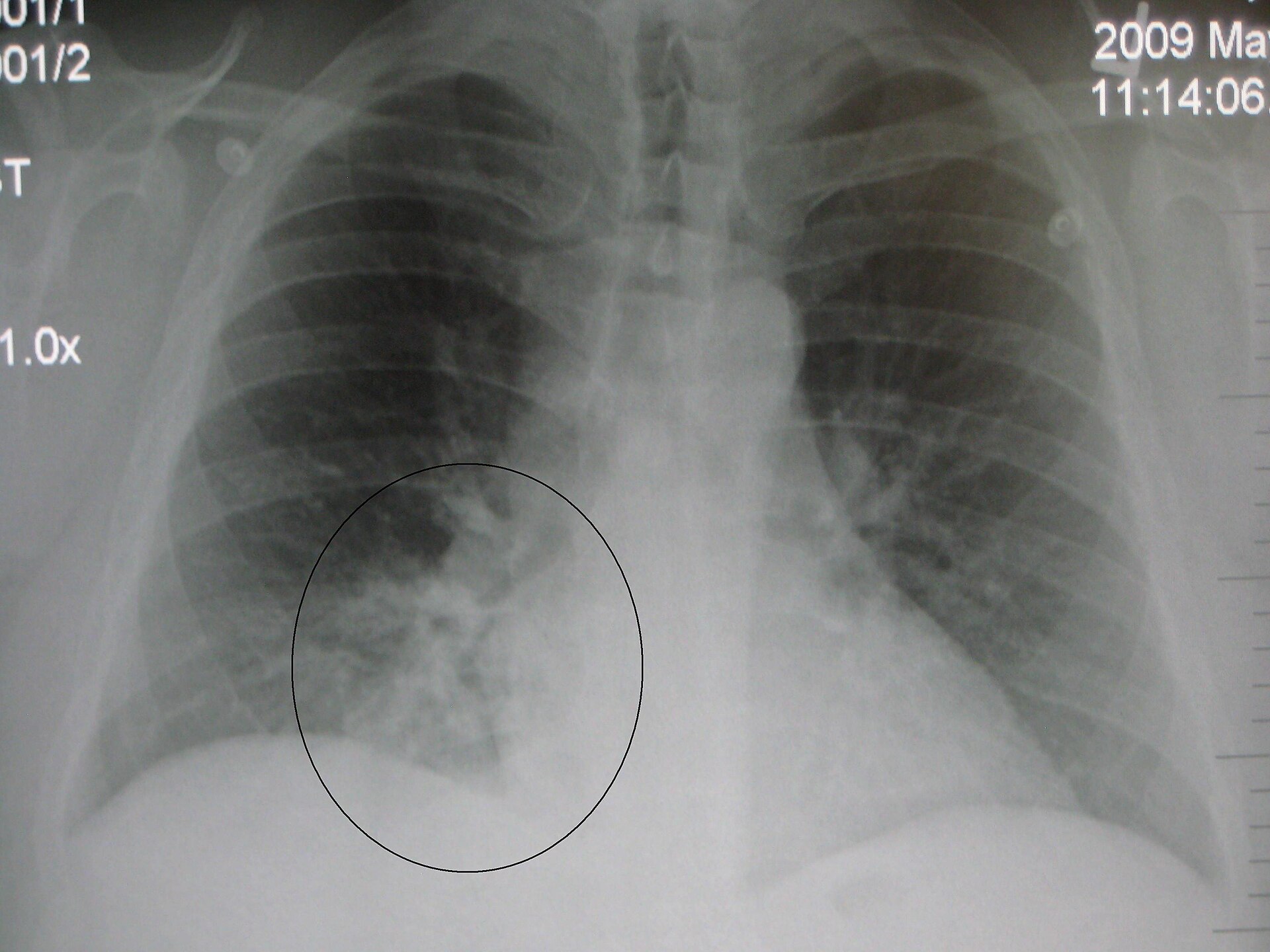 Lobar pneumonia — source media 2