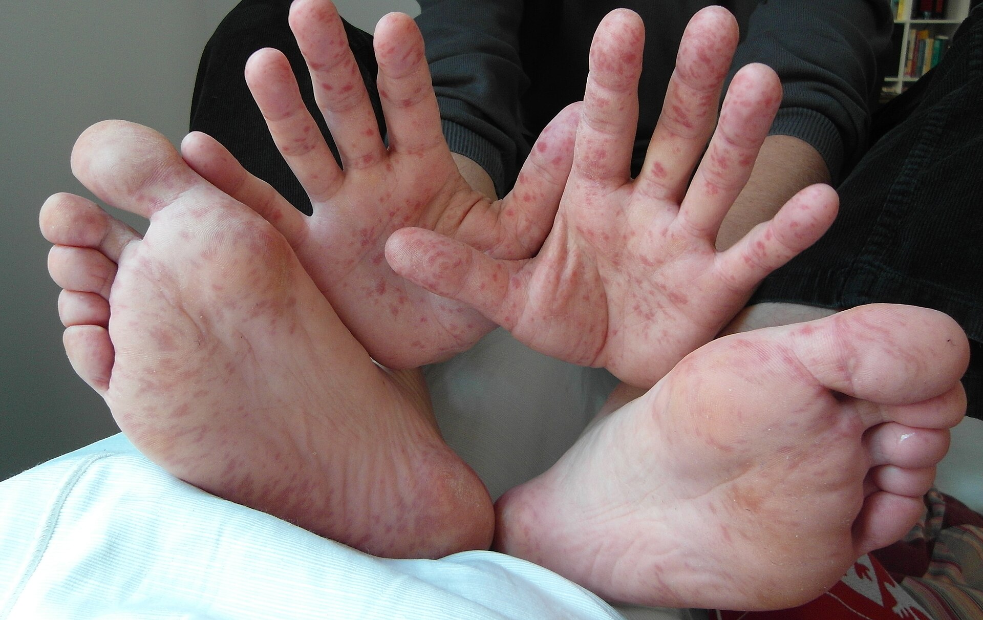 Hand foot mouth disease — source media 2