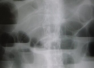 Small bowel obstruction — source media 2