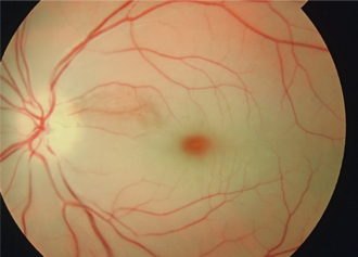 Central retinal artery occlusion — source media 2