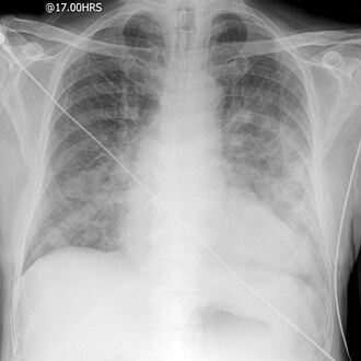Cardiogenic pulmonary edema — source media 2