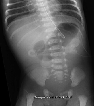 Duodenal atresia — source media 2
