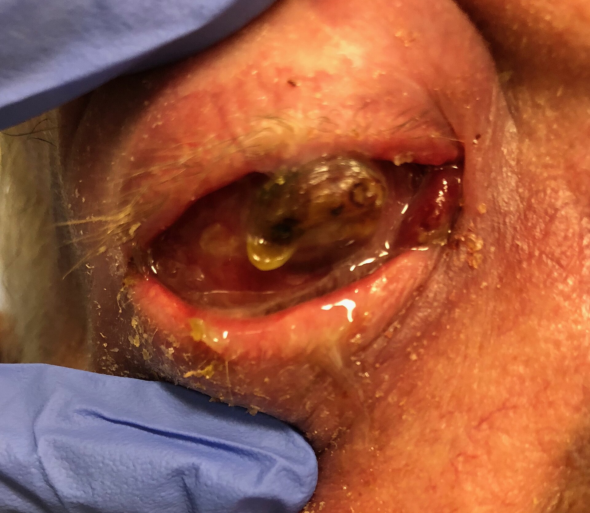 Central corneal white-yellow stromal infiltrate with overlying epithelial defect and… — source media 2