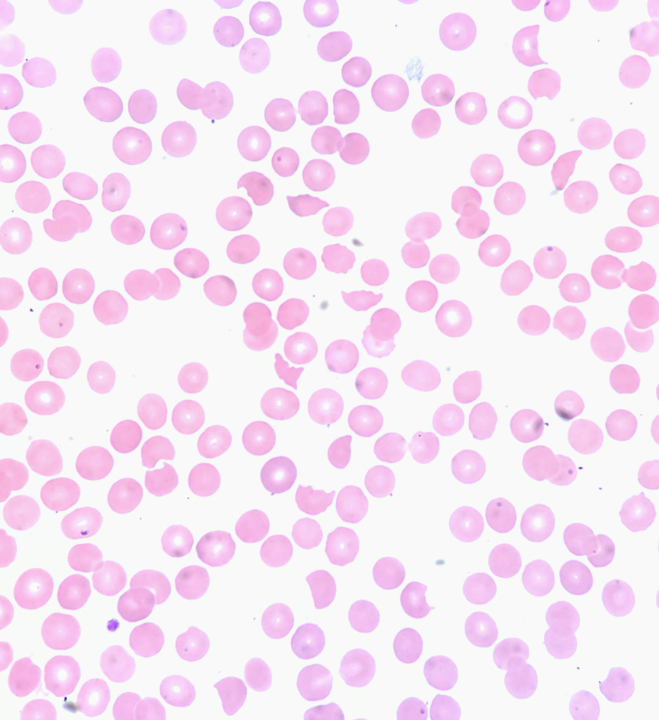 Schistocytes blood smear — source media 3