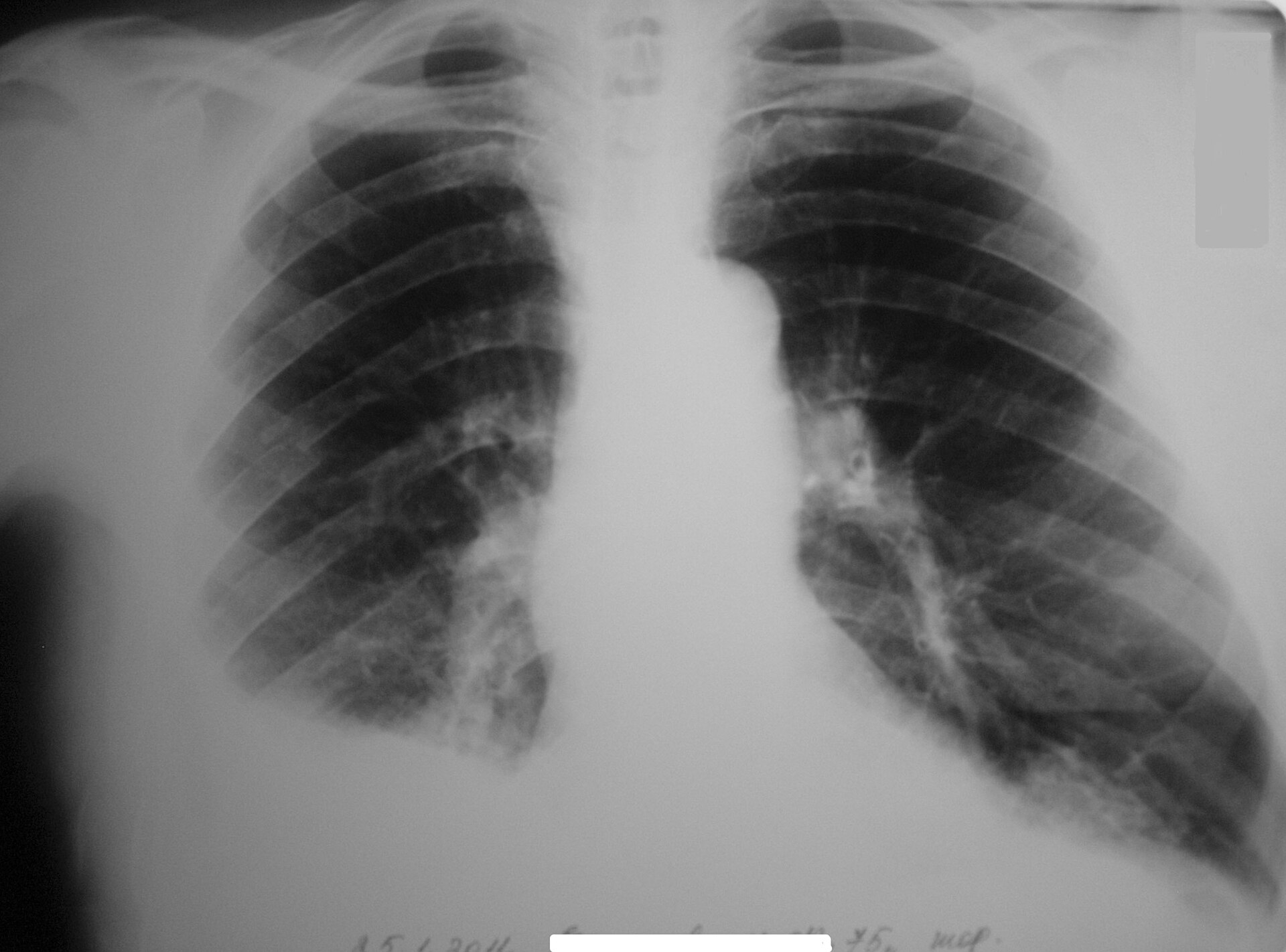 Traumatic hemothorax — source media 2