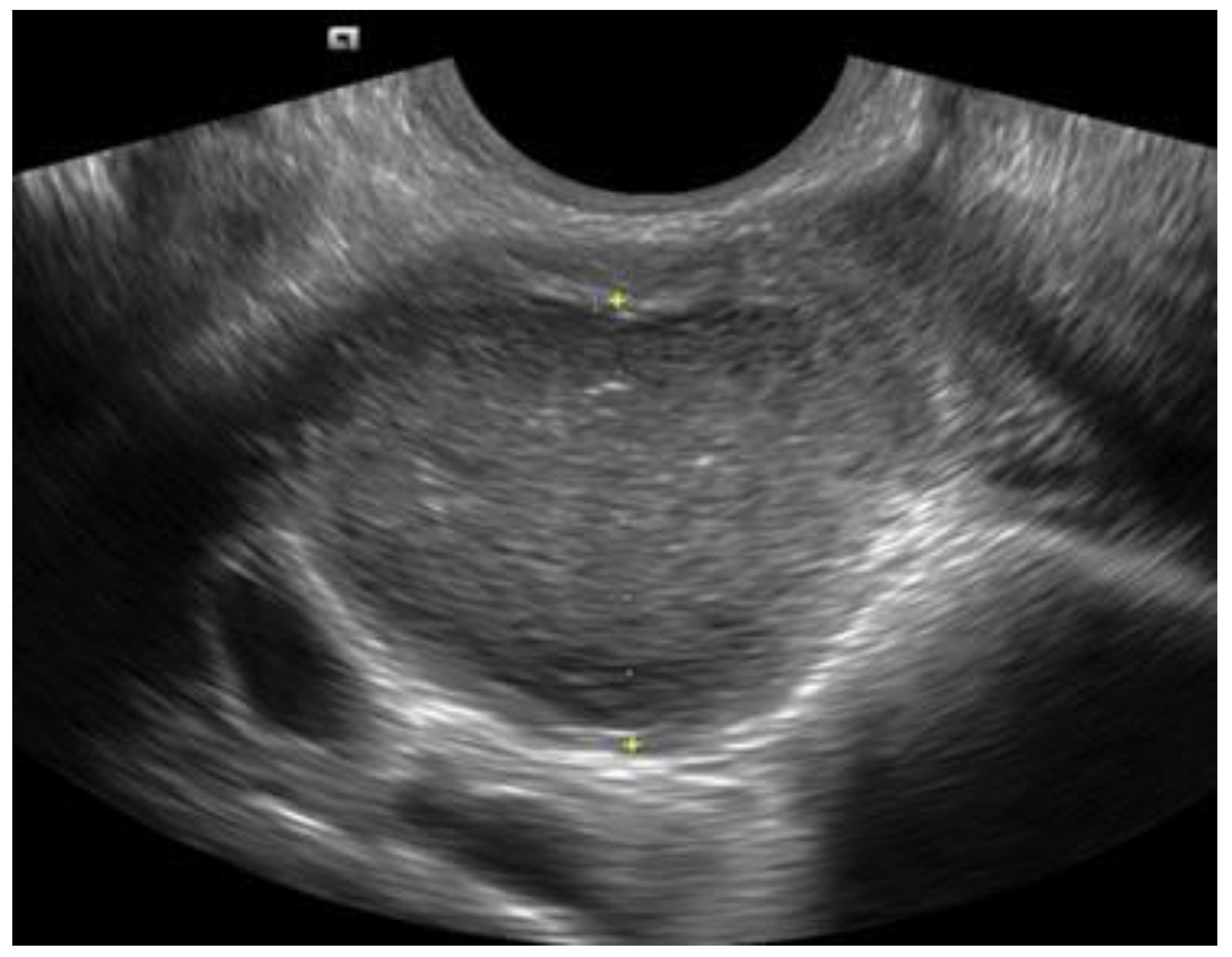 Ovarian endometrioma — ground-glass ultrasound — source media 2