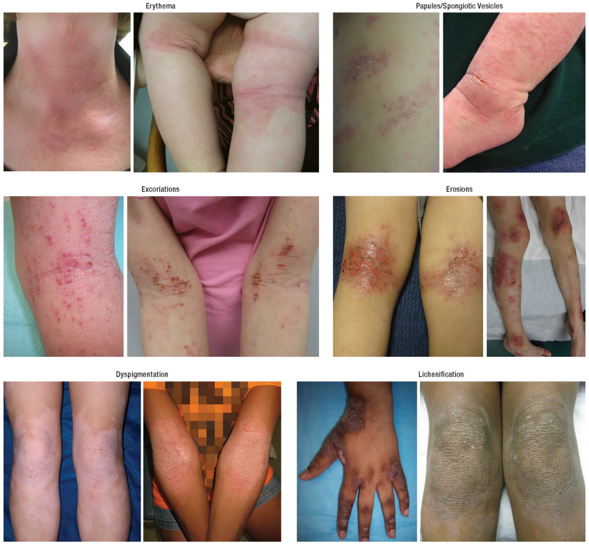 Atopic dermatitis — source media 2