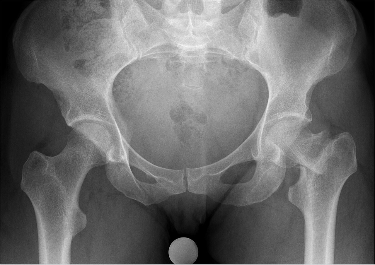 Femoral neck fracture — source media 2
