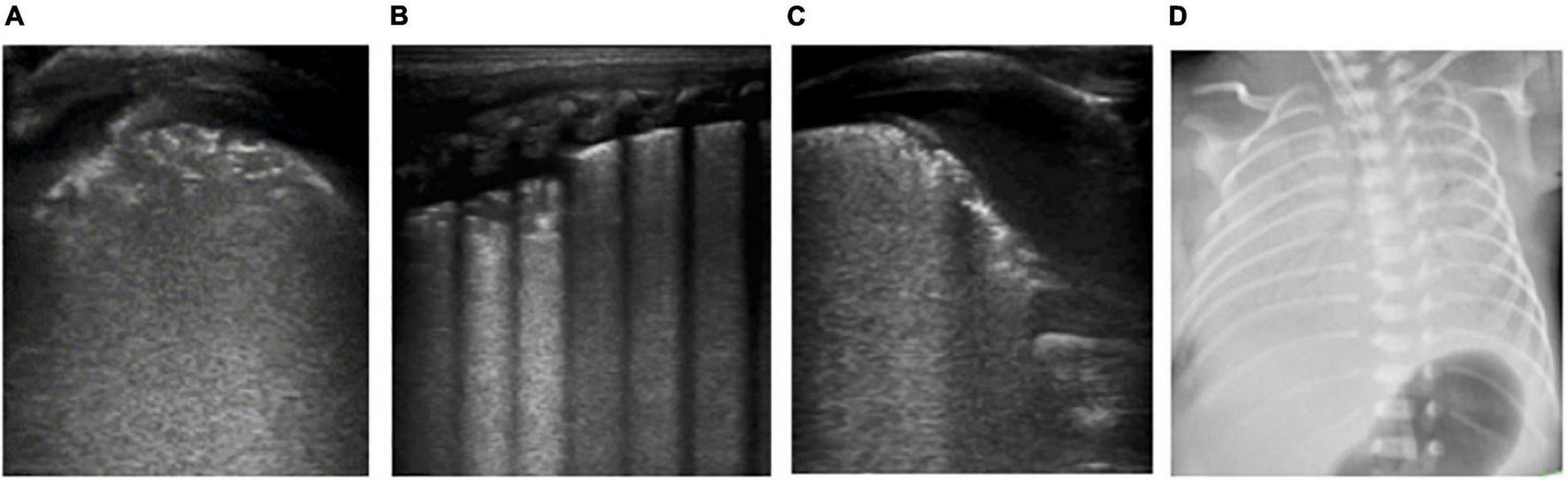 Neonatal respiratory distress — source media 2