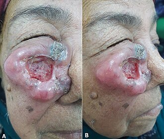 Squamous cell carcinoma — source media 3
