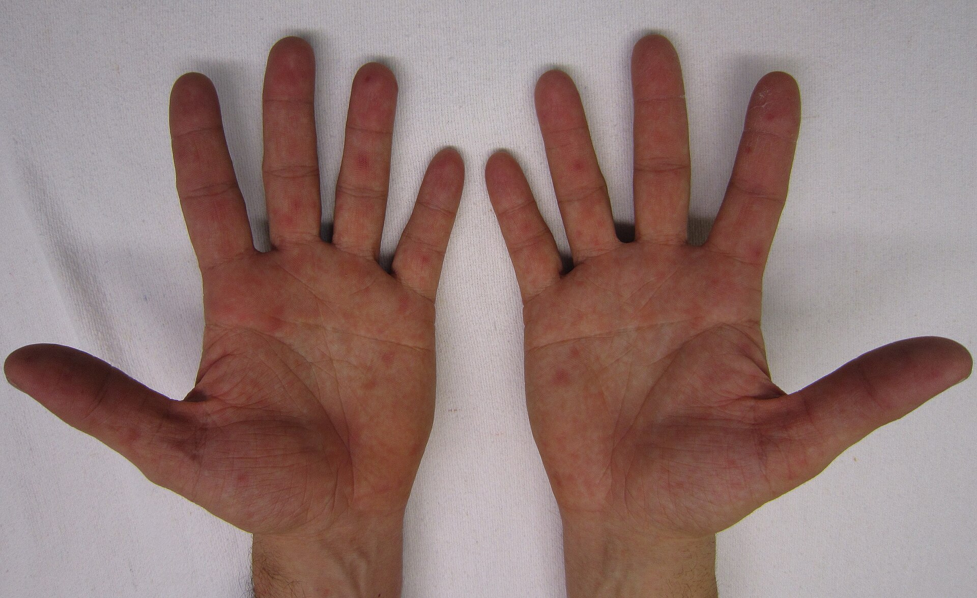 Hand foot mouth disease — source media 3