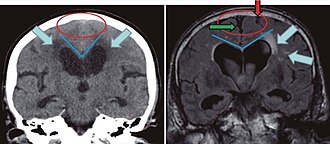 Hydrocephalus CT — source media 3