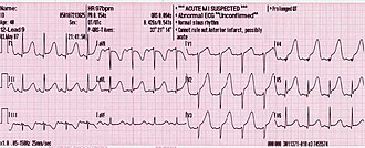 Long QT syndrome — source media 2