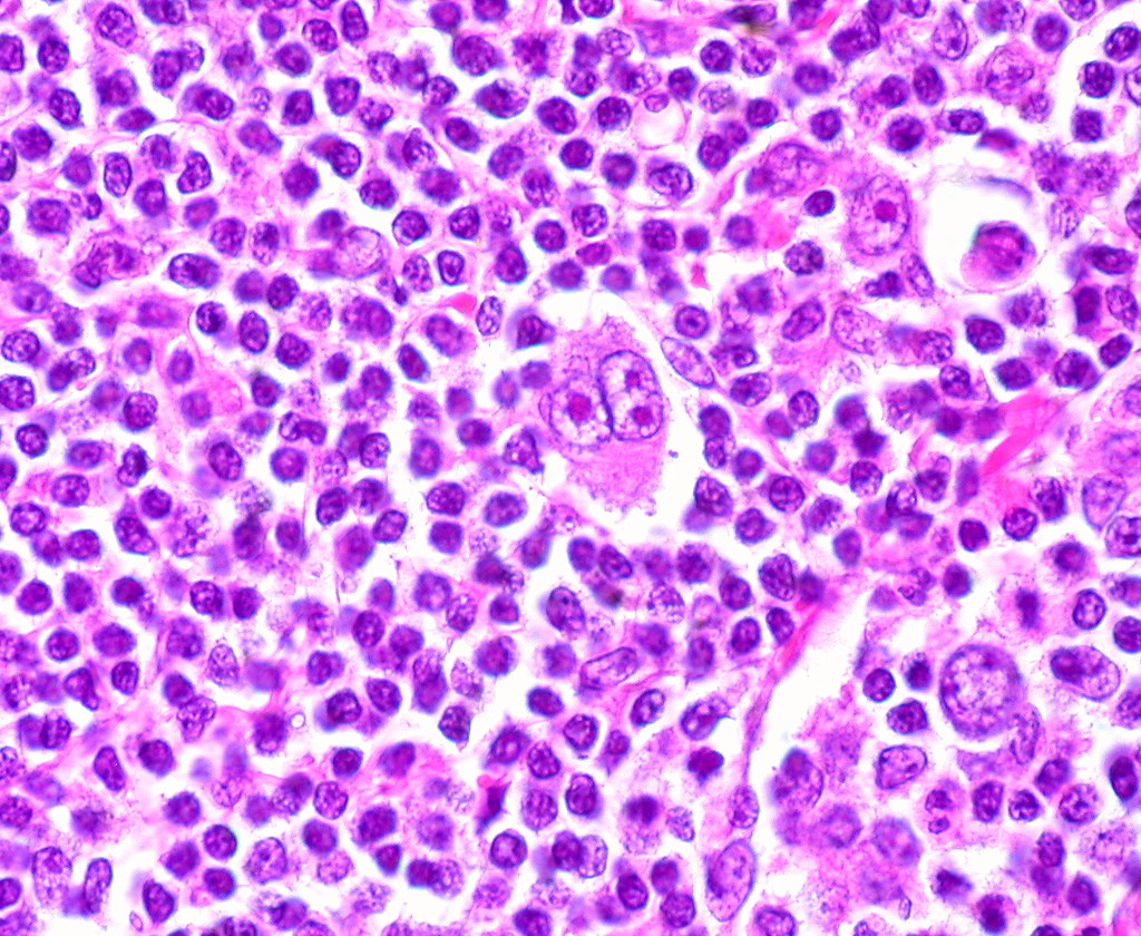 Reed Sternberg cell — source media 2