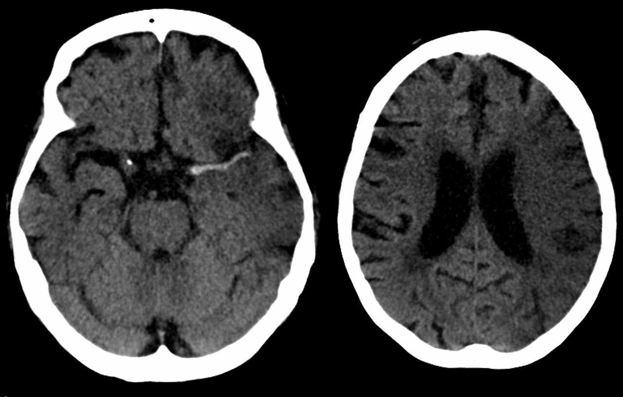 MCA stroke CT — source media 2
