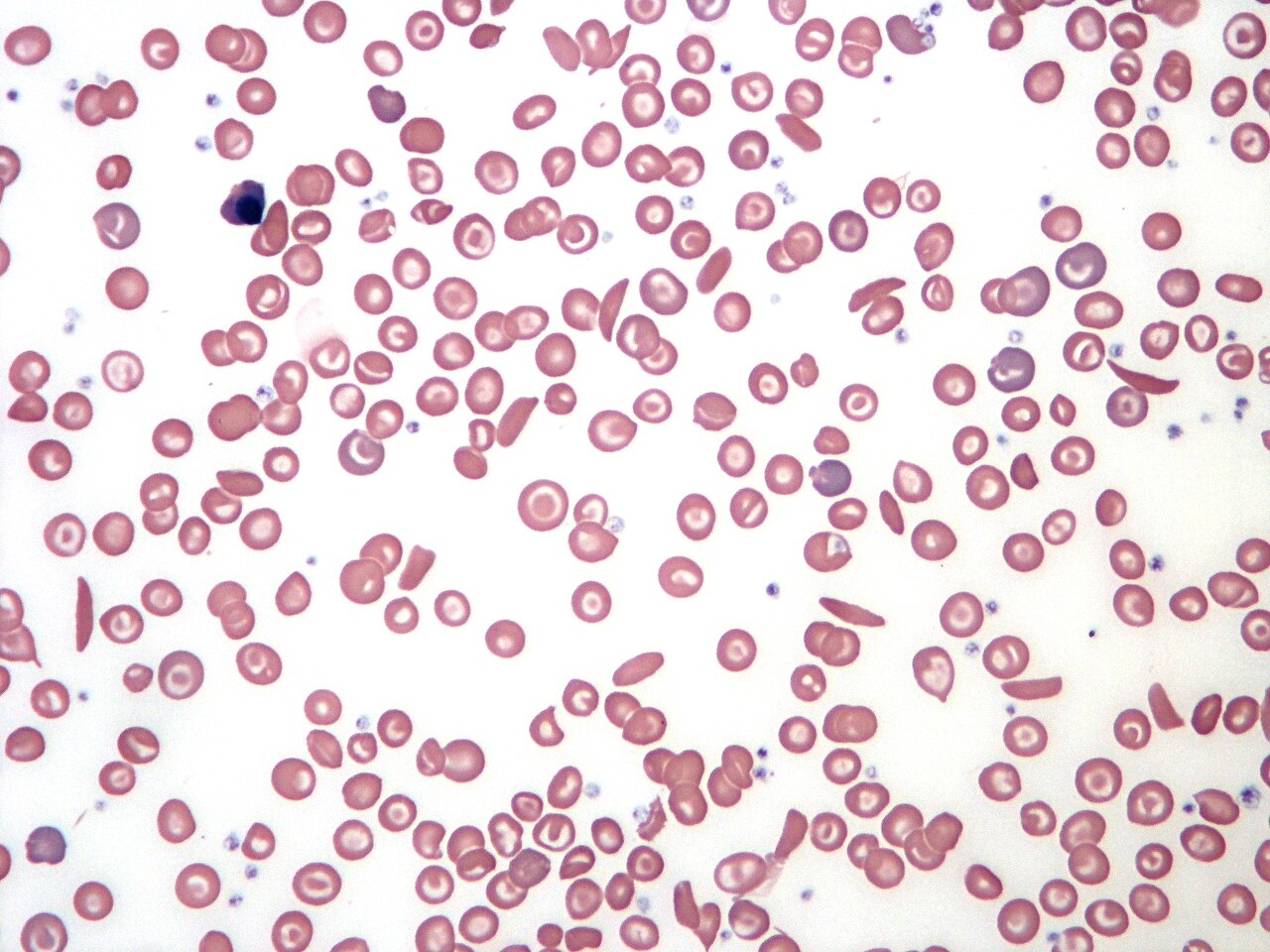 Sickle cell smear — source media 2