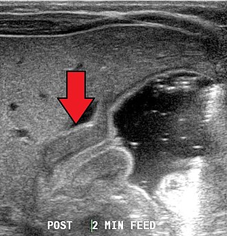 Pyloric stenosis ultrasound — source media 2