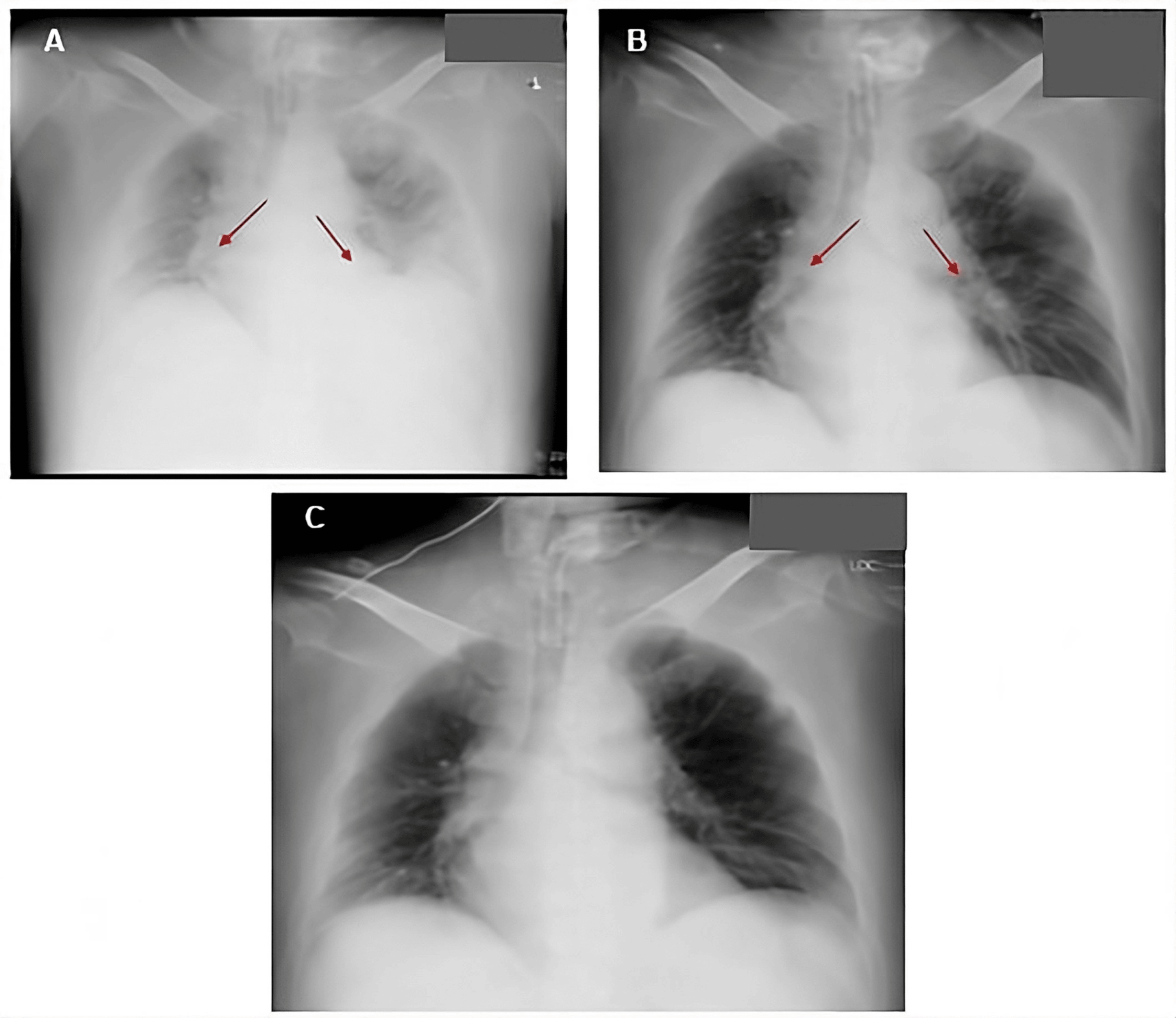 Acute respiratory distress syndrome — source media 2