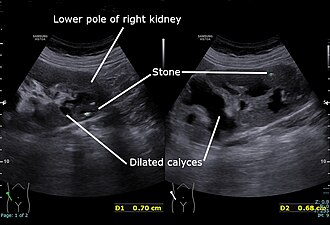 Hydronephrosis ultrasound — source media 3