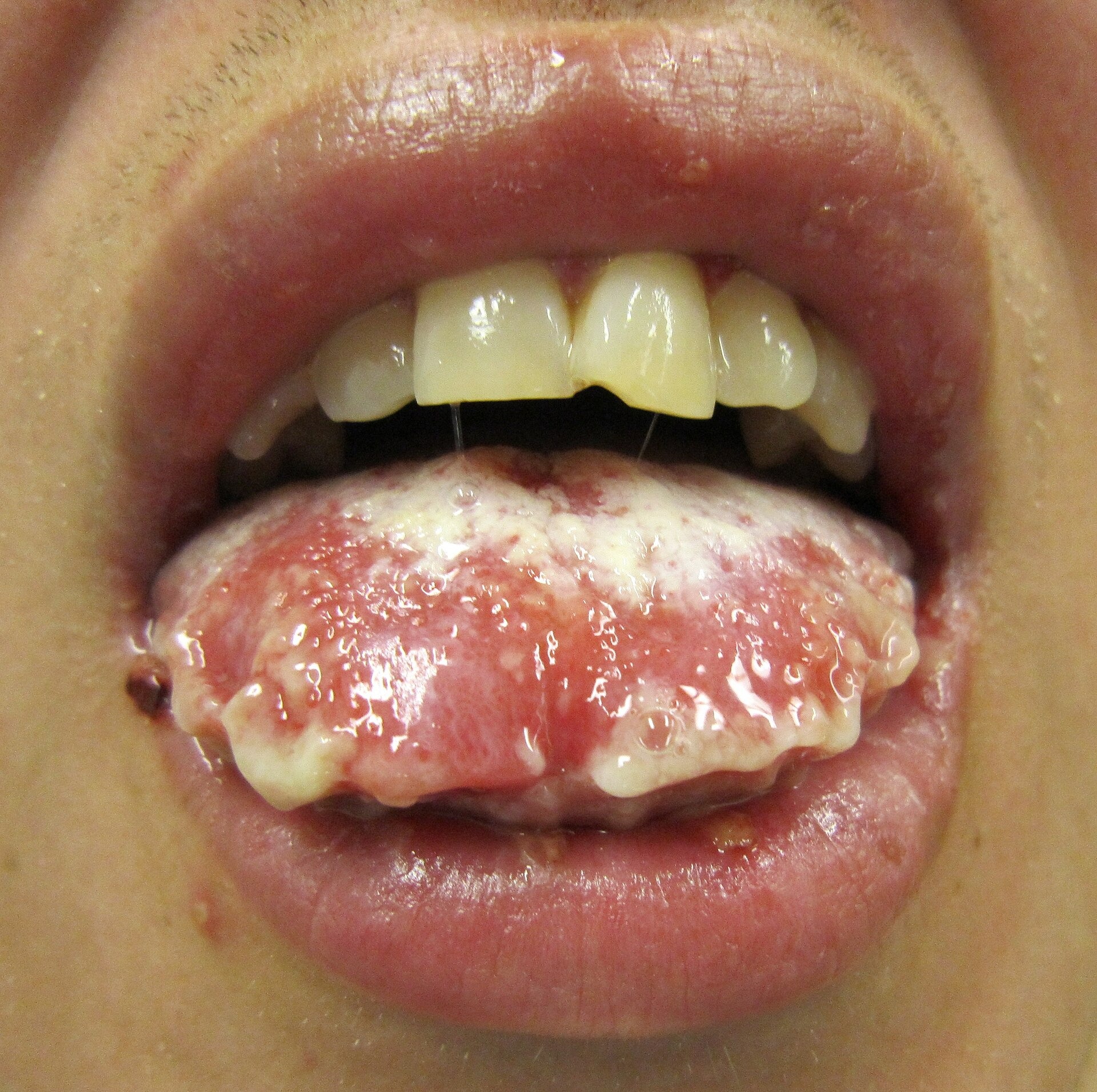 Stevens Johnson syndrome — source media 2