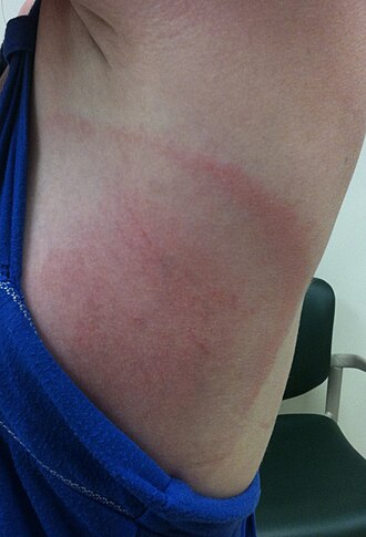 Erythema migrans — source media 3