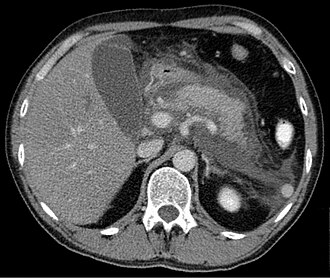 Acute pancreatitis CT — source media 2