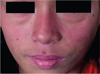 Malar rash lupus — source media 2