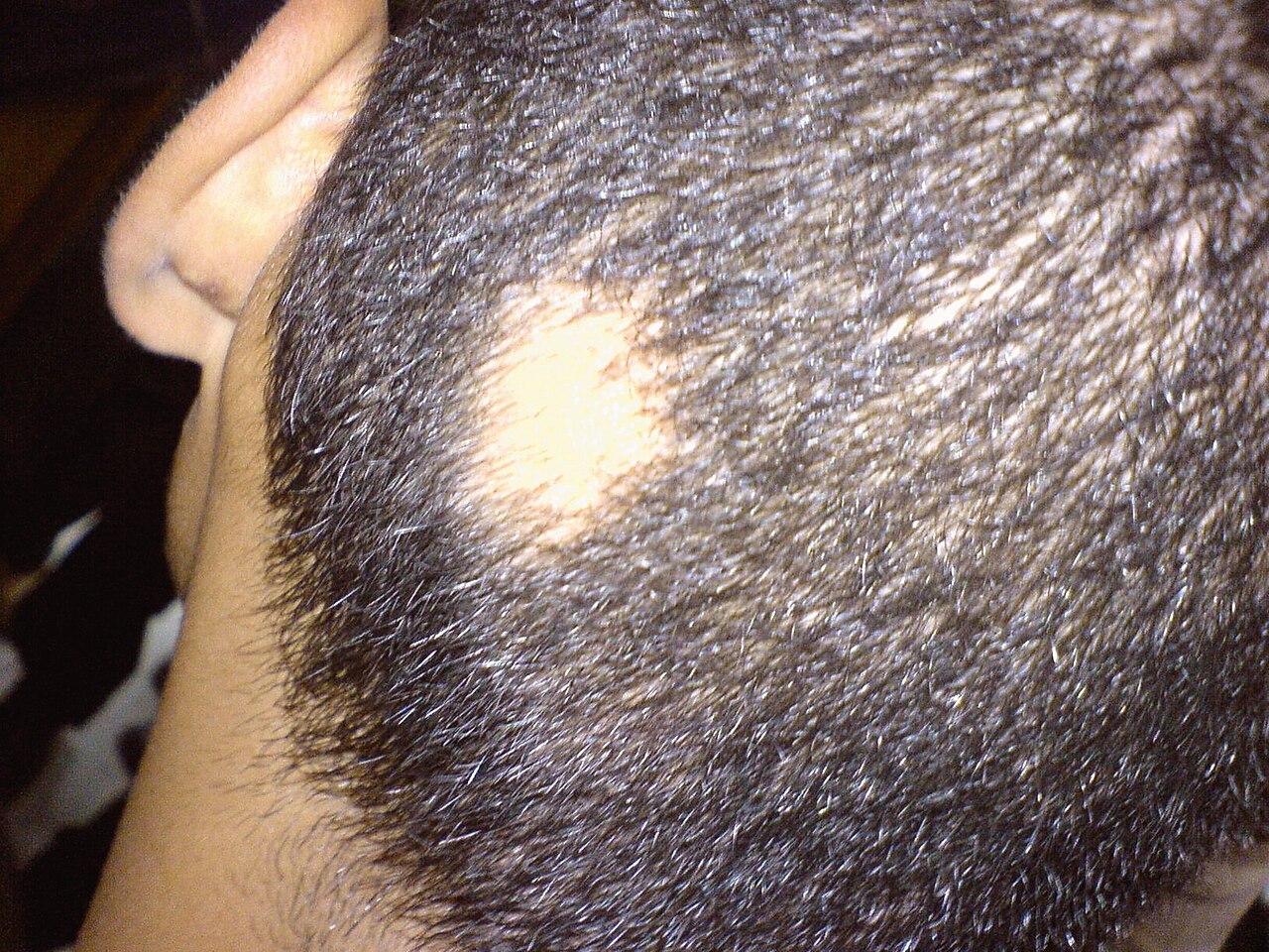 Well-demarcated oval patch of complete, non-scarring hair loss on the vertex scalp… — source media 2