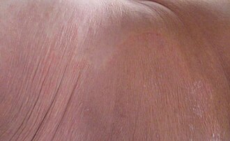 Tinea corporis — source media 3