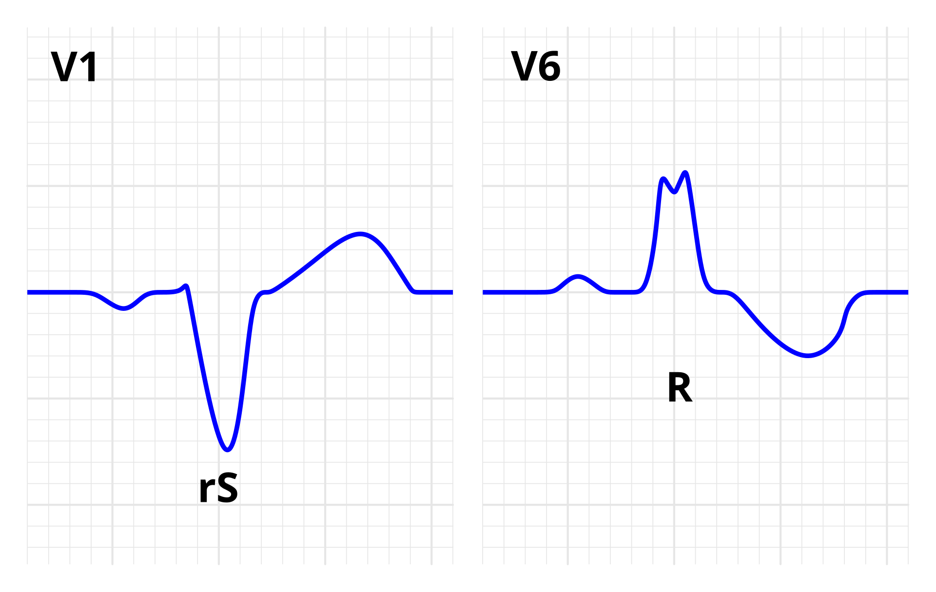 Left bundle branch block — source media 2