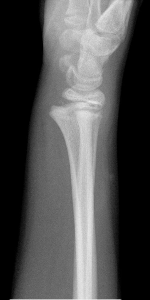 Salter Harris fracture — source media 2