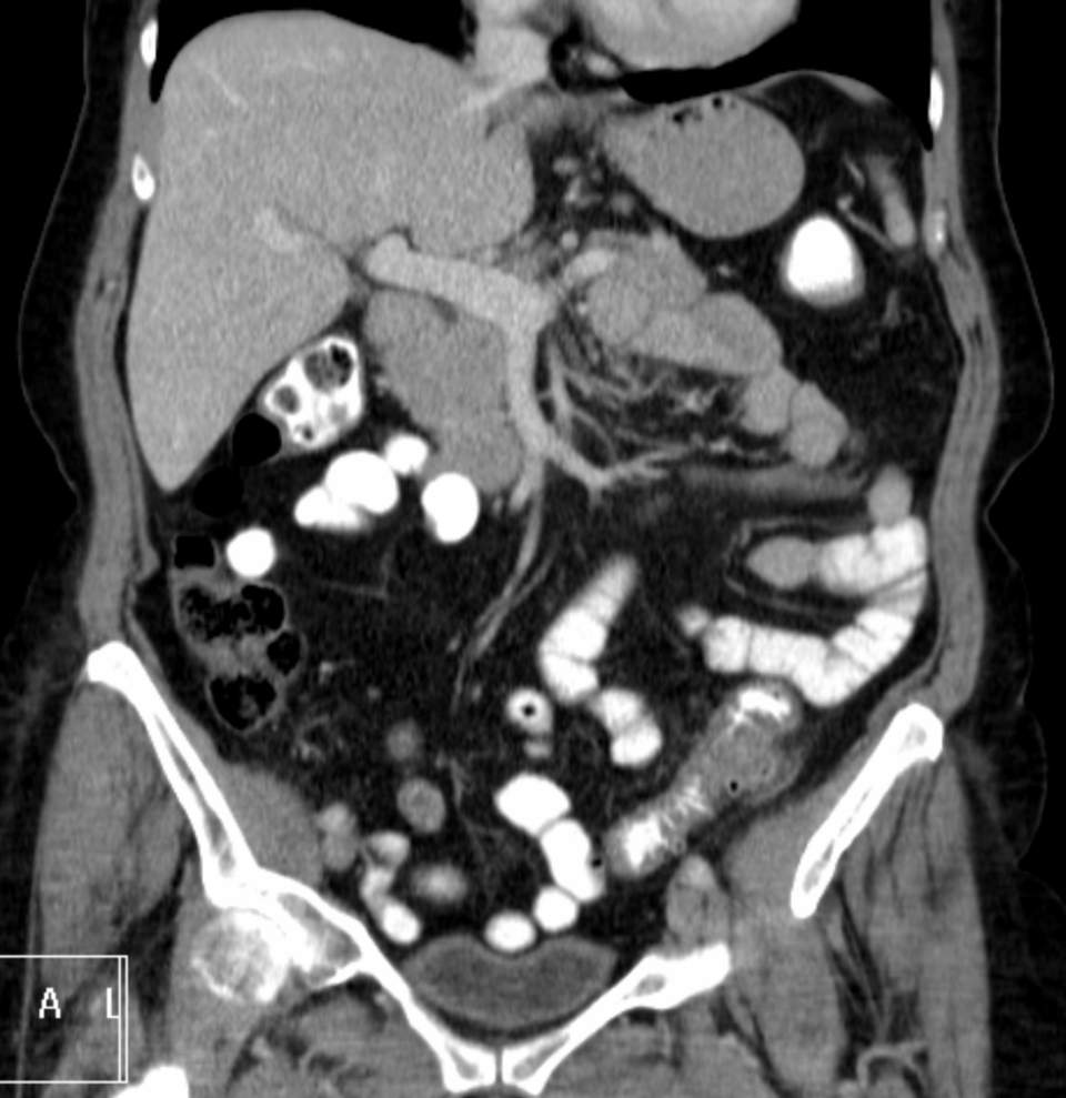 Sigmoid diverticulitis — source media 2