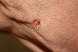 Basal cell carcinoma — source media 3