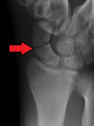 Scaphoid fracture — source media 2
