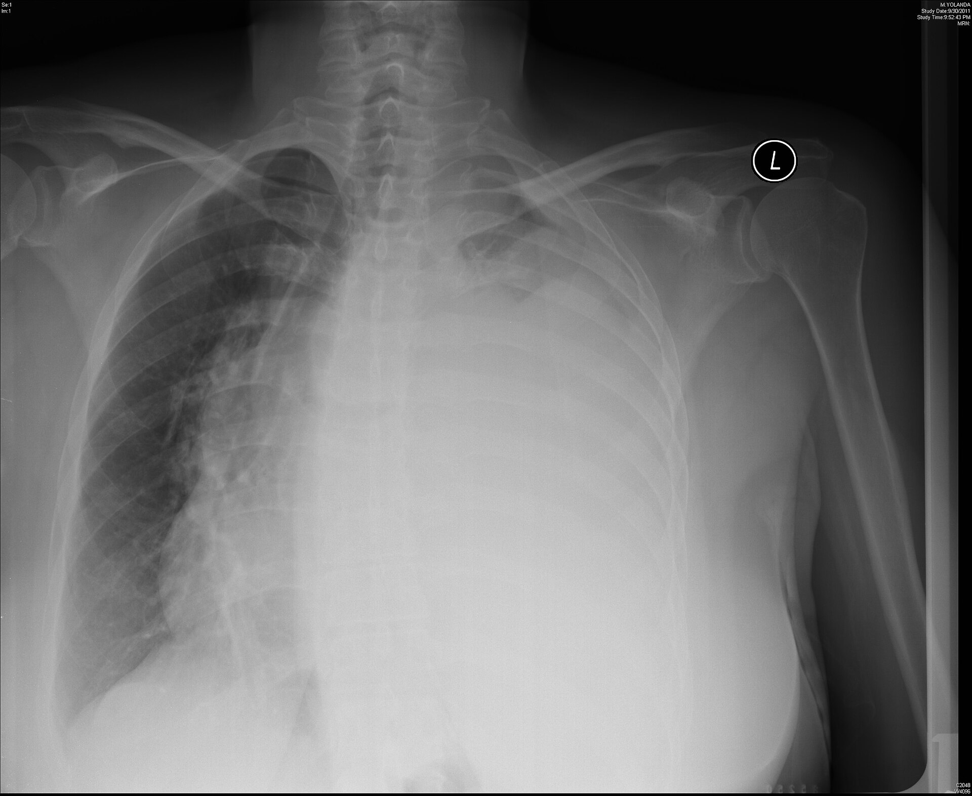 Pleural effusion — source media 2