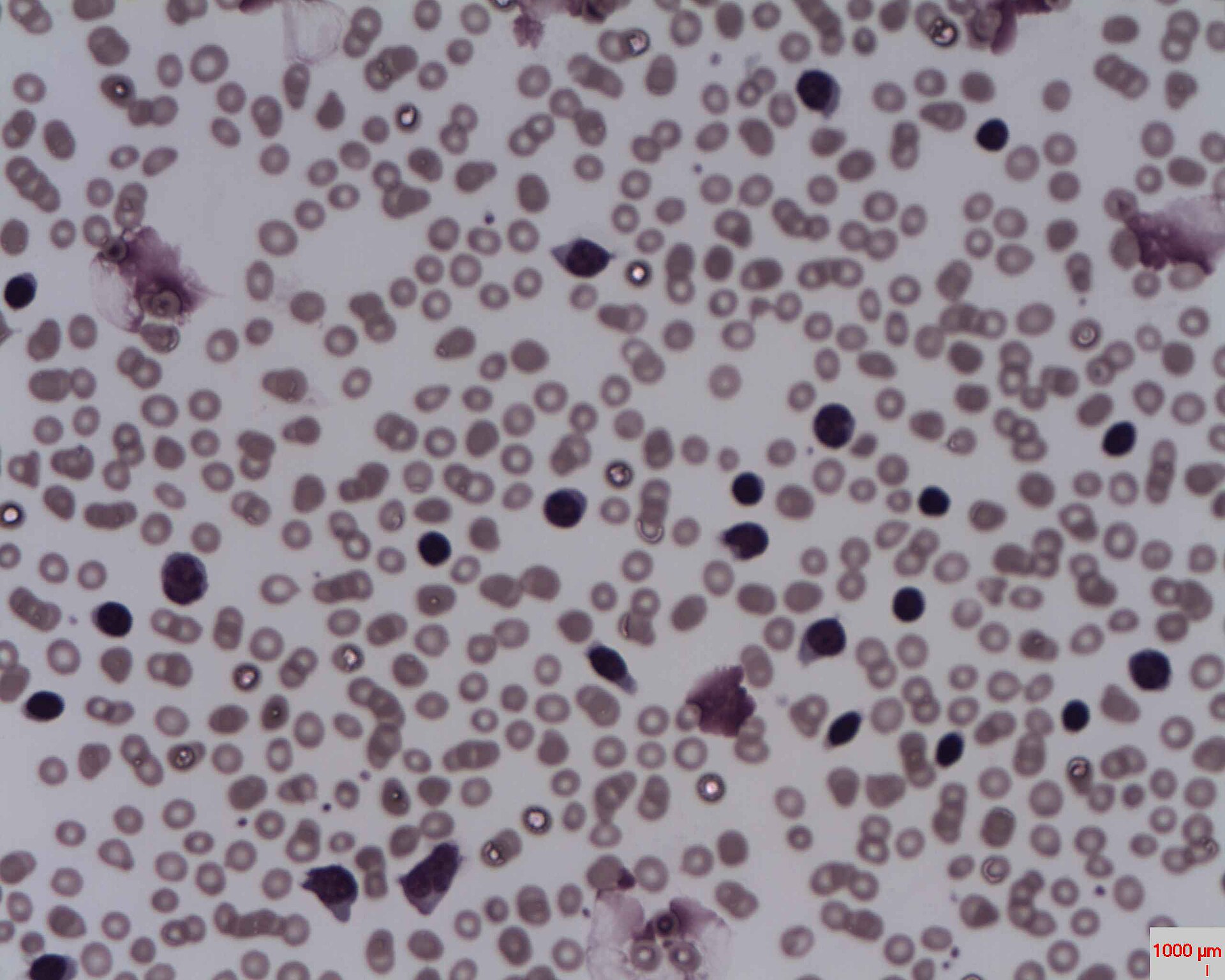 CLL smudge cells — source media 3