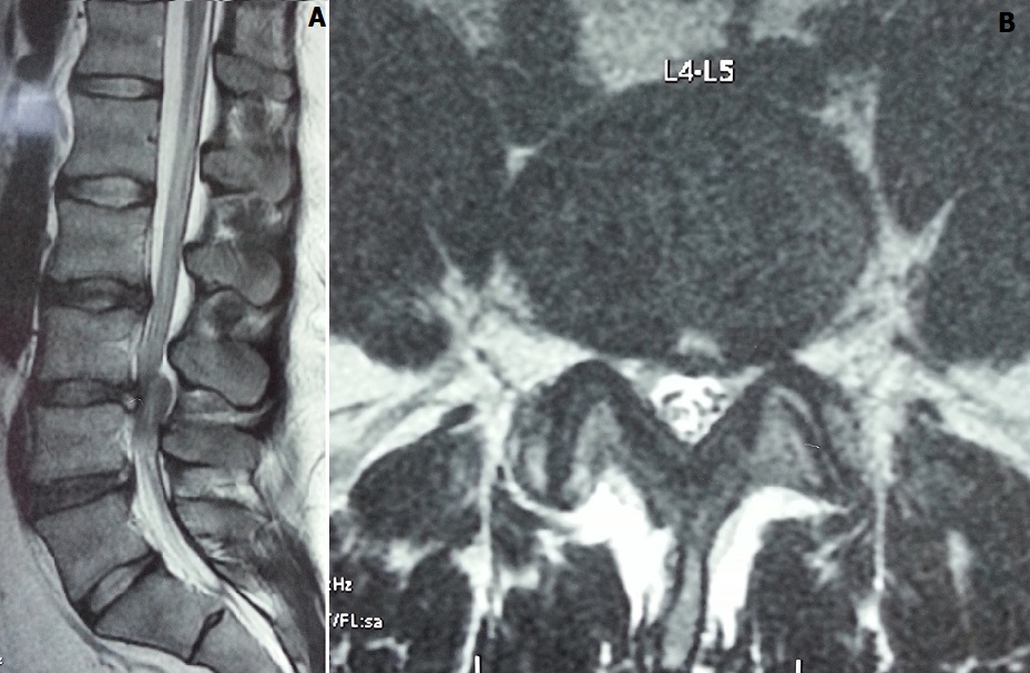 Cauda equina MRI — source media 2