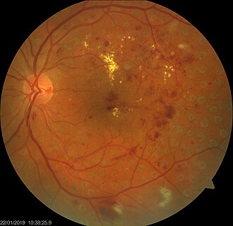 Diabetic retinopathy — source media 2