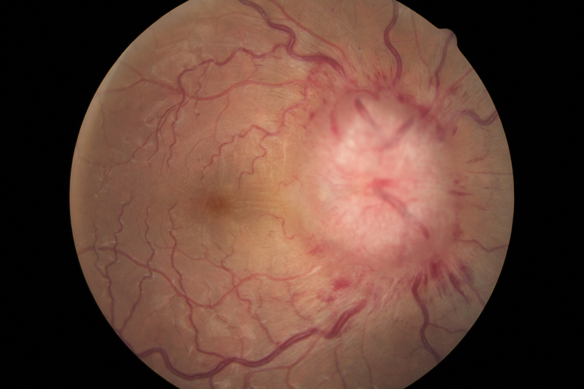 Papilledema fundus — source media 2
