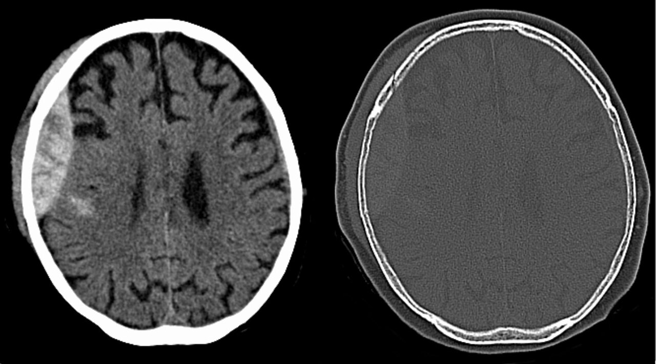 Epidural hematoma CT — source media 2