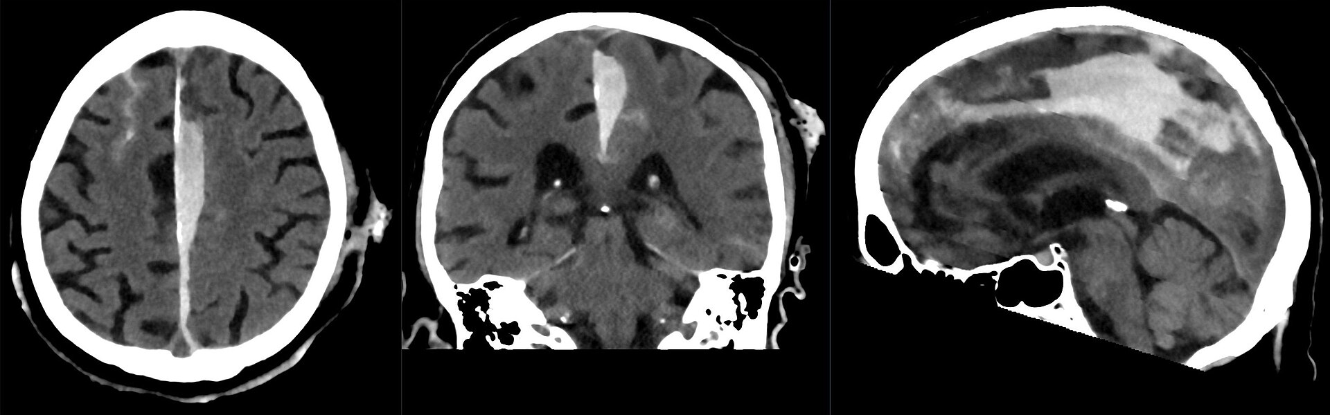 Subdural hematoma CT — source media 2