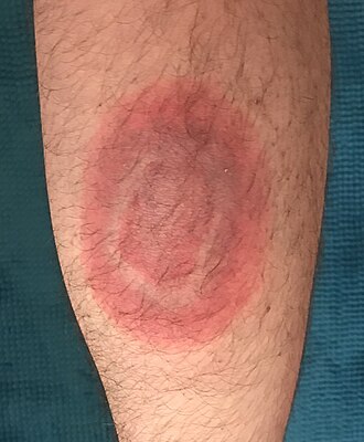 Erythema migrans — source media 2