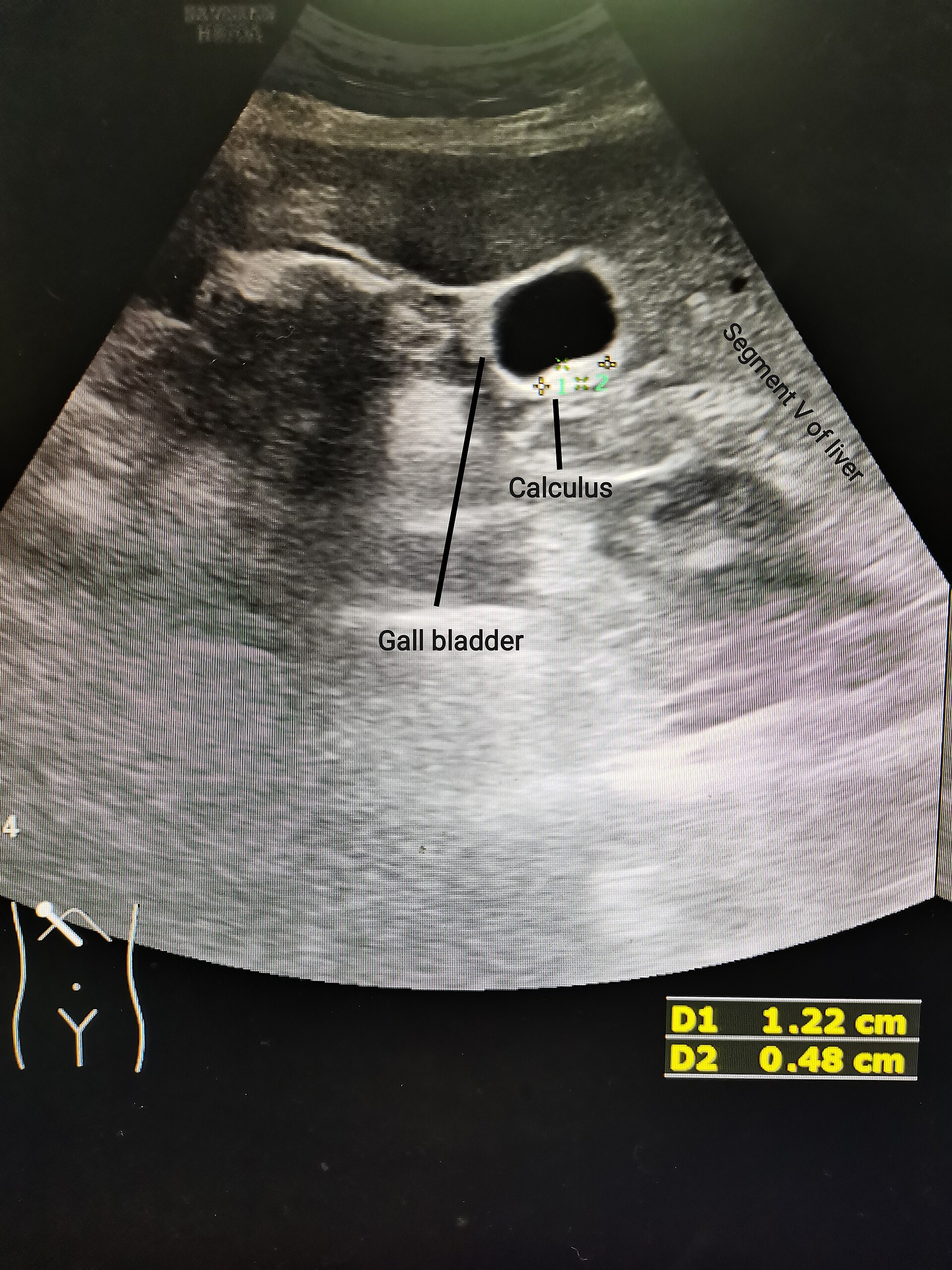 Acute cholecystitis ultrasound — source media 2
